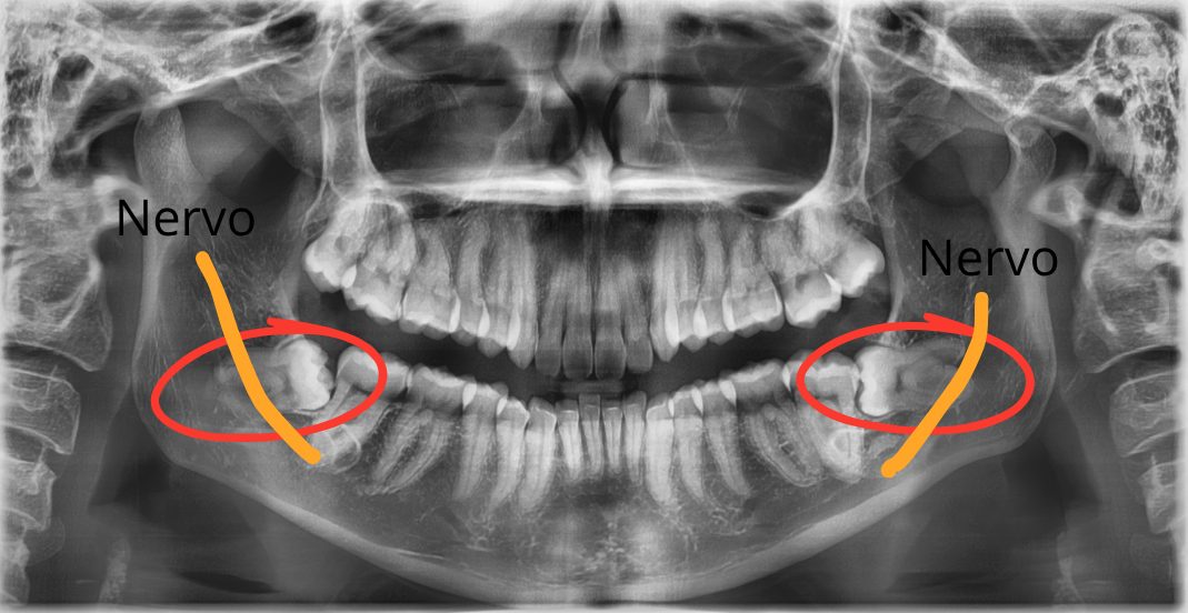 Radiografia panorâmica do caso: raízes dos sisos de baixo próximas ao nervo, dos dois lados